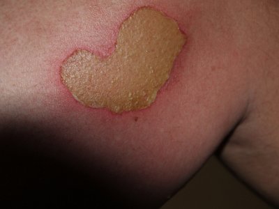 Injured In Myanmar Again